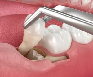 Normal Socket After Tooth Extraction illustration