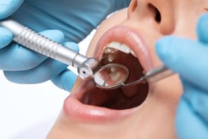 Normal Socket After Tooth Extraction procedure