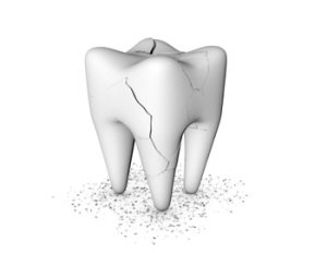 Root Canal vs Extraction crack